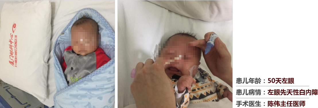 患兒年齡：50天左眼，患兒病情：左眼先天性白內(nèi)障，手術(shù)醫(yī)生：白內(nèi)障科陳偉主任醫(yī)師