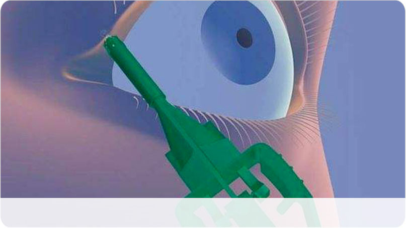 淚小點(diǎn)栓塞術(shù)