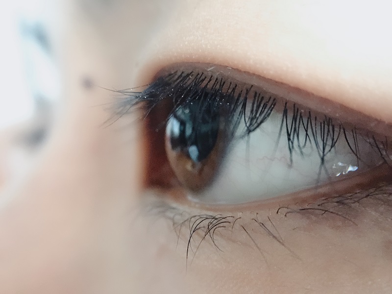 上眼皮為什么會下垂？上瞼下垂是怎么引起的？