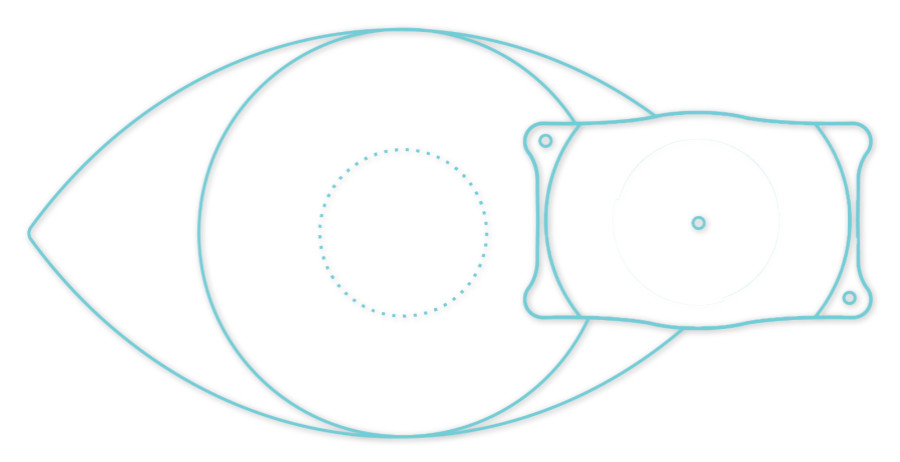 ICL人工晶體植入術(shù)