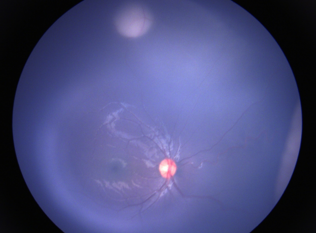 視網膜母細胞瘤