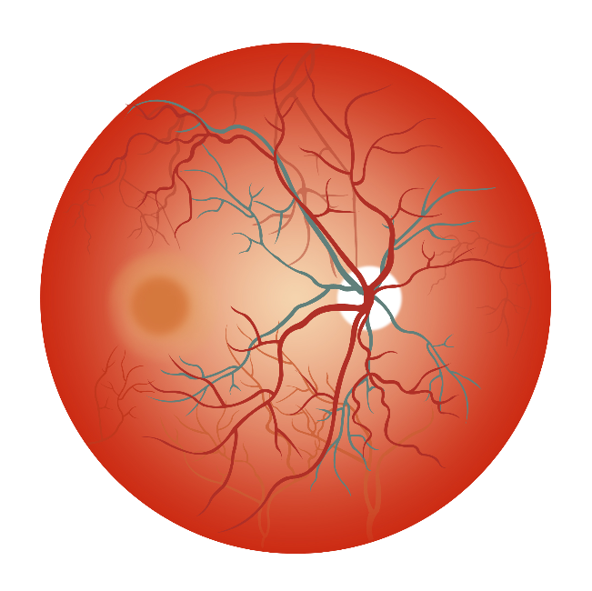 眼底黃斑病變能治好嗎