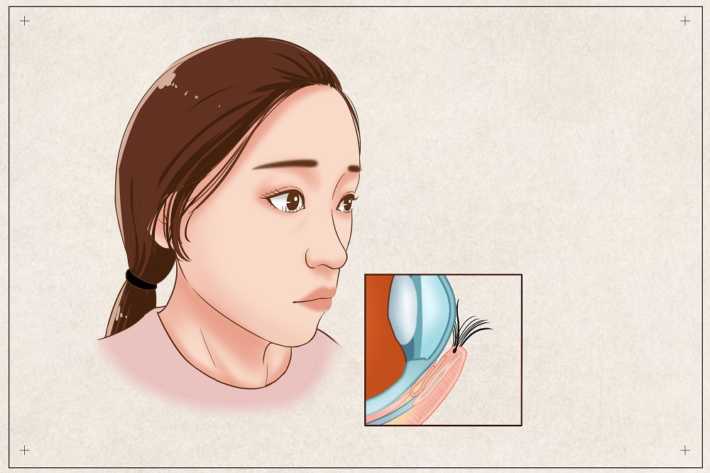 倒睫會自己好嗎？