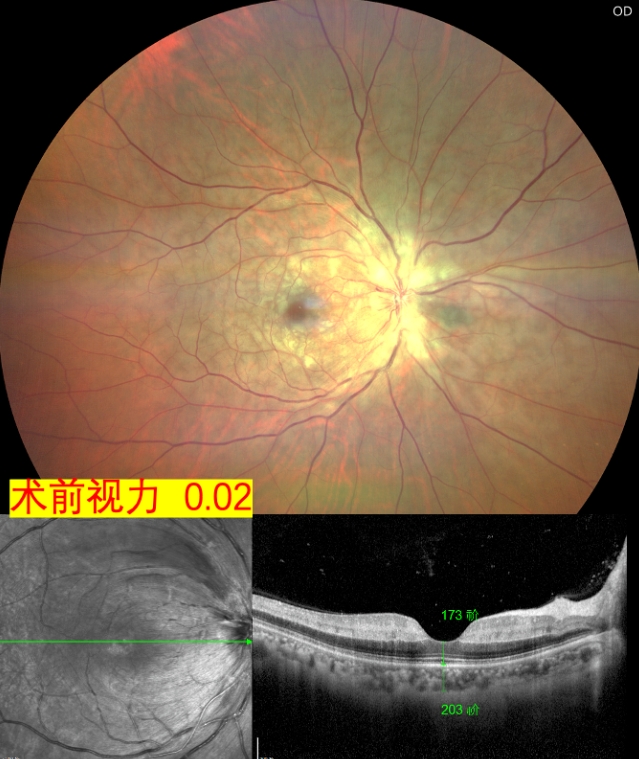 視網(wǎng)膜中央動脈阻塞