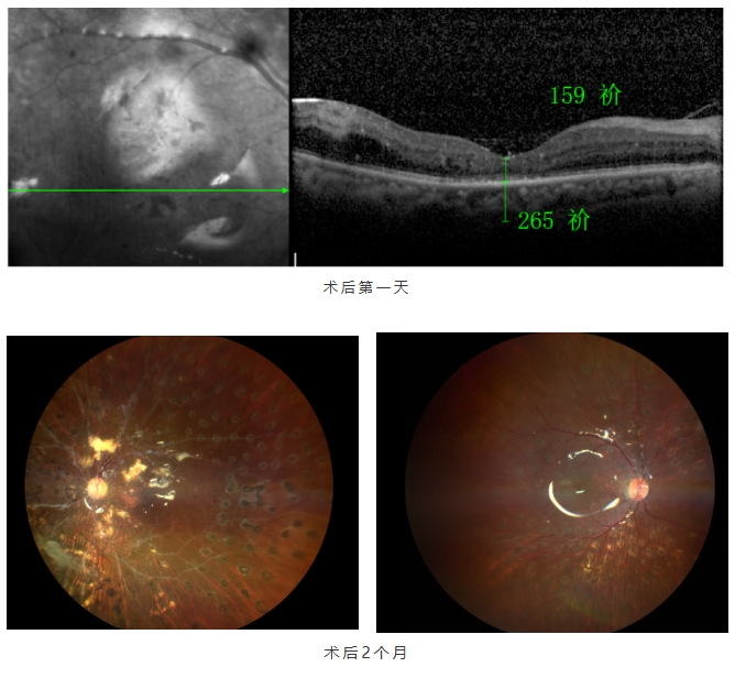 糖尿病視網膜病變