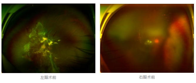 糖尿病視網膜病變